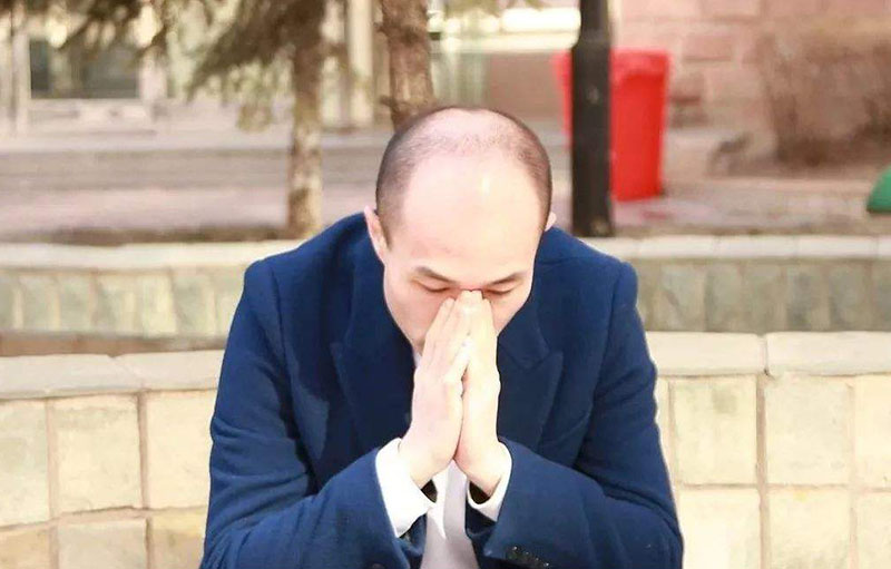 男性脱发