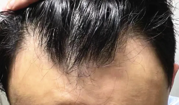 脂溢型脱发最终一定会光头吗？一图识别，附解决方案！